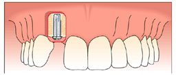single tooth implant