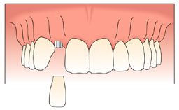 Dental Implant Treatment Solutions