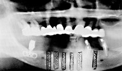 Xray