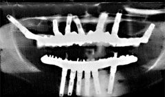 Xray