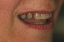 Teeth In A Day