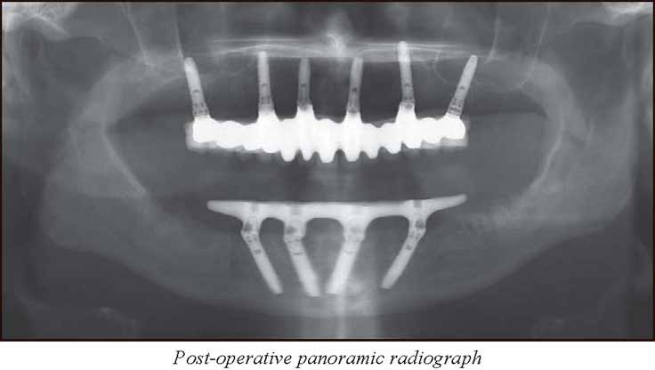 Post Op Panorex Xray