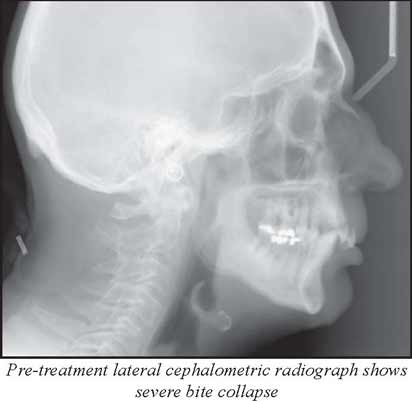 Cephalometric Xray