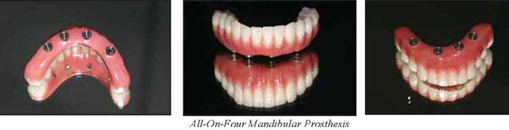 All On Four Prosthesis
