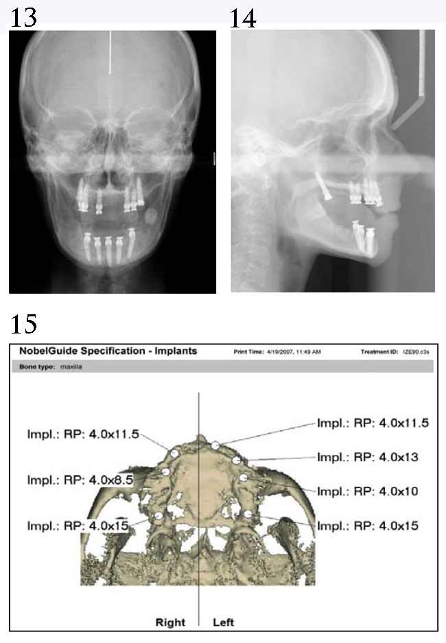 Cephalometric Xrays
