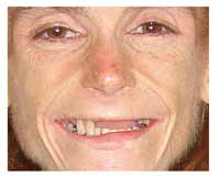 dental implant patient