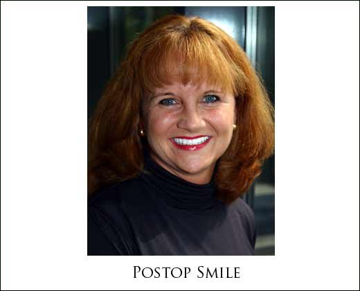 Preop full face