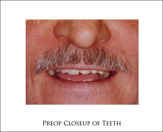 Preop closeup