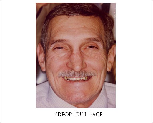 Preop face