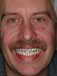 Interum teeth