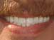 Postop closeup