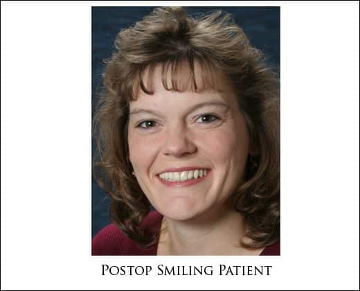 Preop full face
