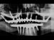 Postop xray