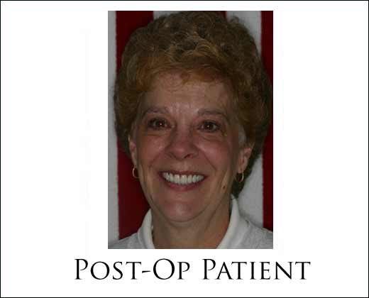 Preop full face