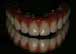 Zirconium All-Ceramic Crowns