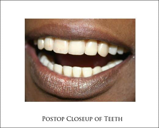 Postop closeup