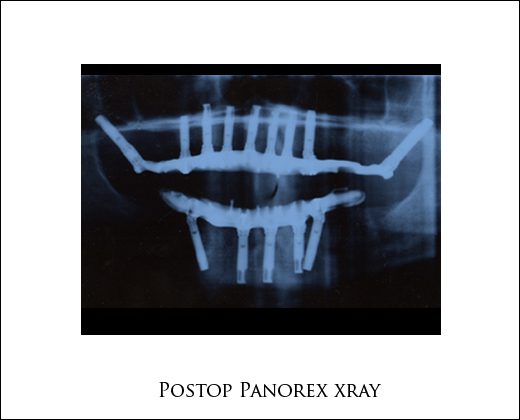 Postop Panorex