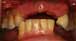 Pre Treatment Teeth