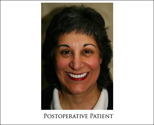 Preop full face