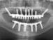 Postop xray