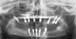 panoramic radiograph for teeth in a day