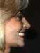 Lower implant rehabilitation provides lip support