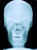 Postop xray