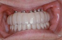 gingival mask