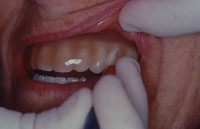 gingival mask