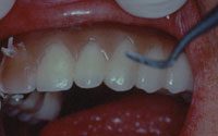 gingival mask