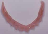 gingival mask