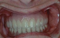 gingival mask
