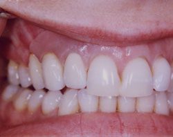 Gingival Mask