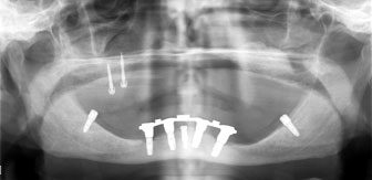 Preop Xray