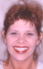 An attractive smile is just one more reason to choose dental implants