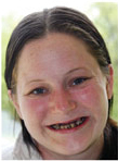 Patient prior to dental implant treatment