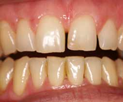 Tooth prior to veneer placement
