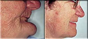 Dental Implant Prosthesis Provides Support For The Face And Improves the Profile