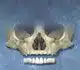 Zygomatic Implants