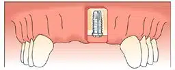 Anterior Tooth Replacement with Dental Implants