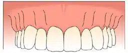 Anterior Tooth Replacement with Dental Implants