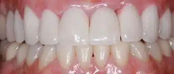 Emax