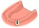 Full Lower Dental Implant Treatment