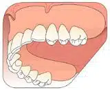 An overdenture is attractive and cost effective option.
