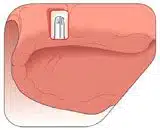 Placement of dental implants in preparation for an overdenture.