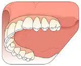 Placement of a Fixed Prosthesis by attaching it to the dental implants.