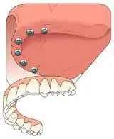 Dental Implant Treatment Replacing Teeth for the Full Upper Arch Begins with Dental Implant Placement.