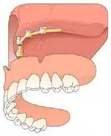 A full arch removable prosthesis snaps into place.