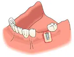 Posterior Replacement
