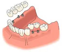 Posterior implants